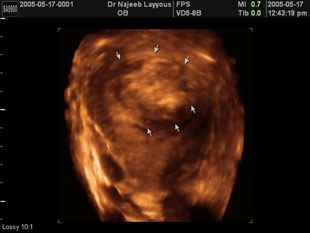 Col de l'utérus fibrome