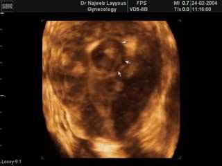 utérus fibrome