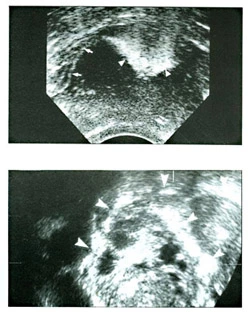 contraste-de-hysterosalpingo-sonography