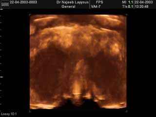 Diffuse 3D hypertrophie de la thyroïde