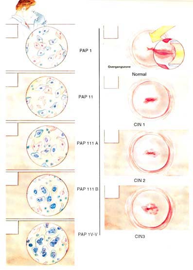 Du PAP et du Colposcope changements cervical