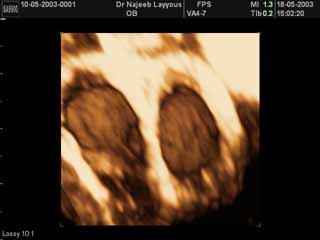 Echographie fœtale scrotale