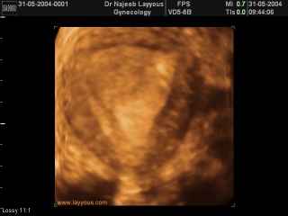 Échographie transrectale montrant utérus normal