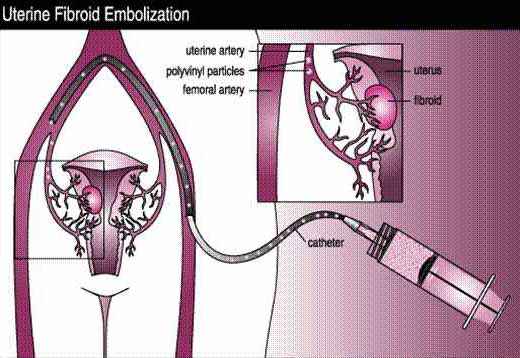 Embolization fibroide utérin