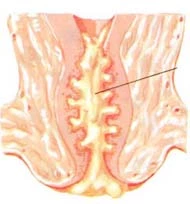 Endometriosis