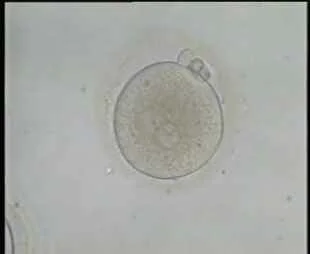 Magnified 3 Pronuclei in abnormally fertilized Oocyte