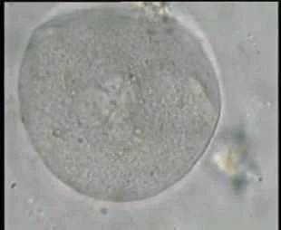 Fertilized Oocyte with clear two Pronuclei and 2nd polar body