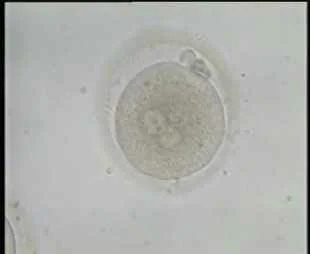 Fertilized Oocyte with abnormal wide perivitelline space