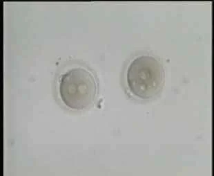 Abnormal Fertilization with Multiple Pronuclei