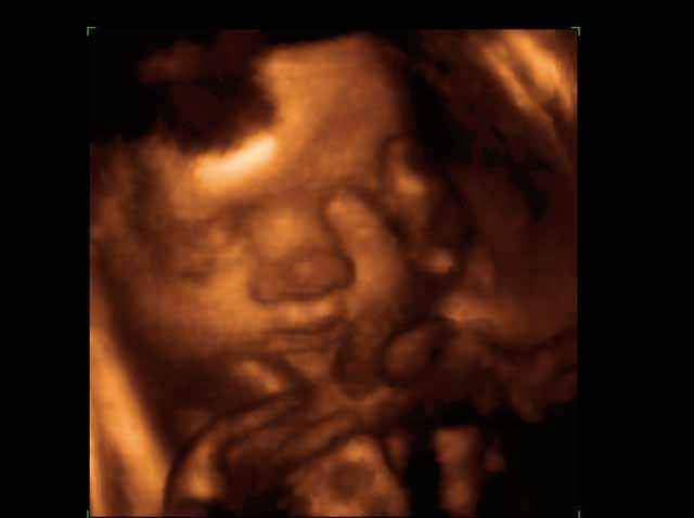 Fœtus de 35 Semaines