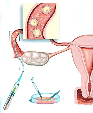 Gamete Intra-Fallopian Transfer (G.I.F.T)