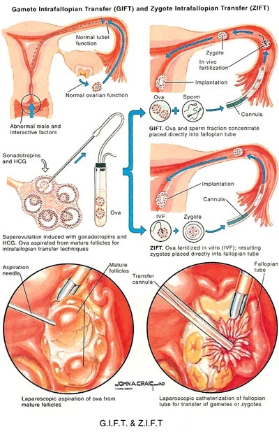 Gamete and zygote Intra-Fallopian Transfer