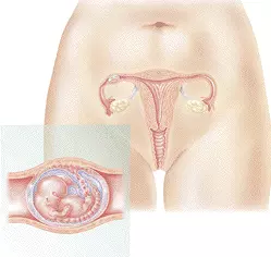 grossesse-extra-utérine