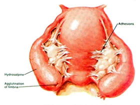 hydrosalpinx