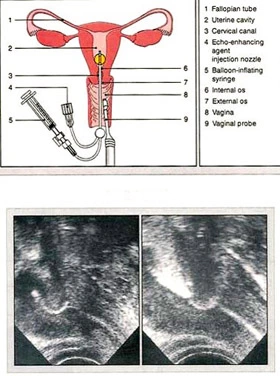 Hysterosalpingo Contrast Sonography