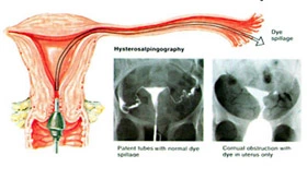 hysterosalpingogram