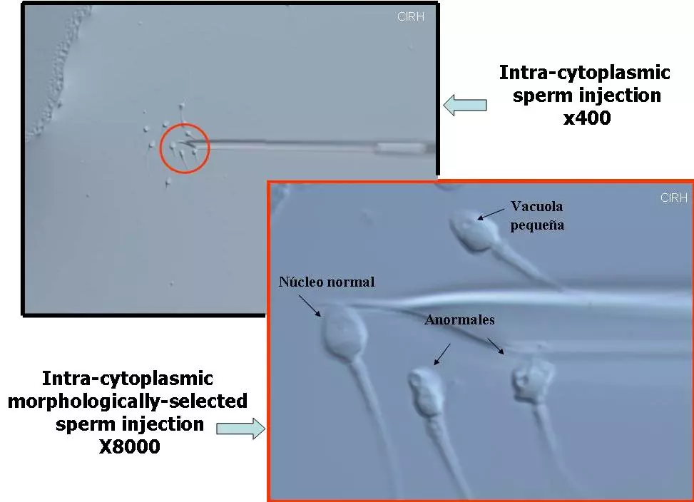 Injection intra-cytoplasmique de spermatozoïdes morphologiquement sélectionnés x8000