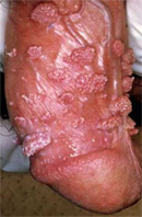 Les verrues d'Anogenital