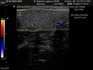 Normale lobe droit de la thyroïde avec Doppler