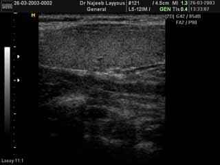 Normale lobe droit thyroïde