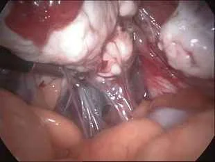 Ovarian adhesions