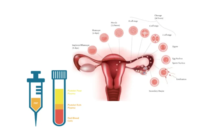 injection de plasma dans les ovaires