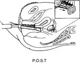 Peritoneal Oocyte and Sperm Transfer