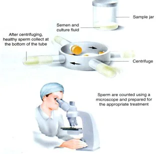 Preparation for Intra Uterine Insemination