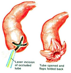 salpingostomy