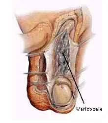 testicular-varicocele