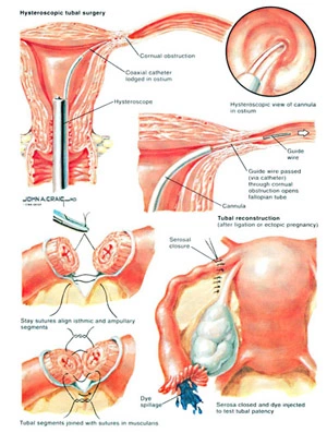 traitement-chirurgical-pour-l'infertilité-femelle