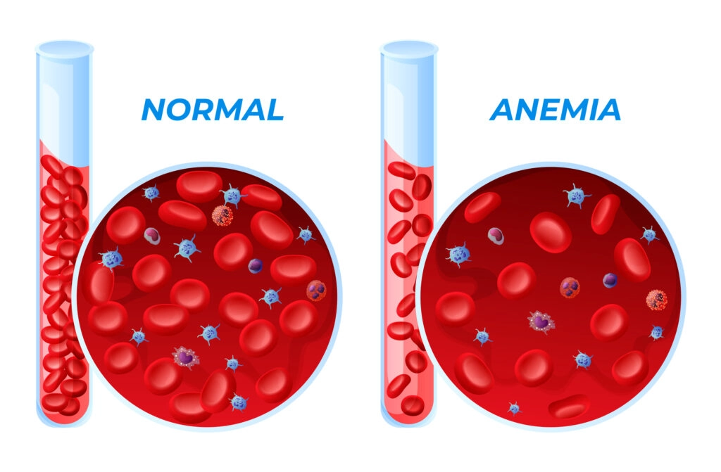 Anemia and its relation to fertility