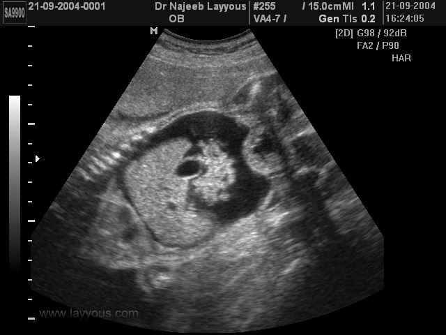 Fetal Ascitis