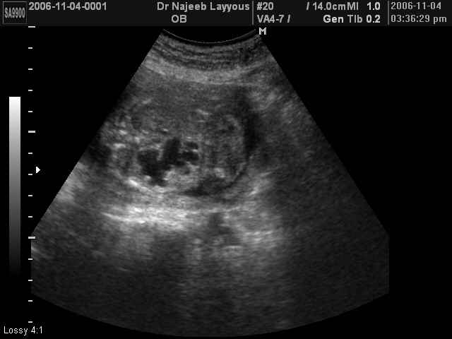 Fetal Kidney Hydronephrosis