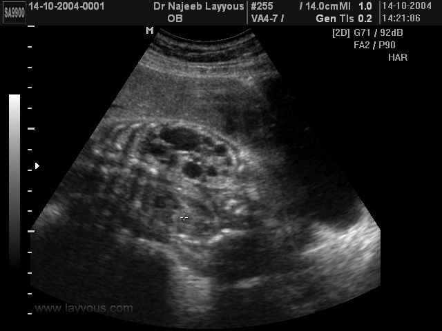 Rein Polycystique Foetal