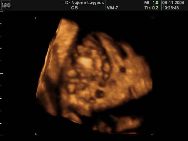 Fetal Polycystic Kidney
