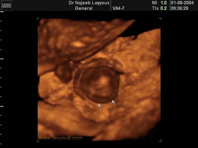 Placental Chorioangioma