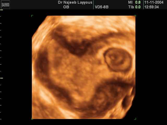 La grossesse dans un côté d'utérus Arqué