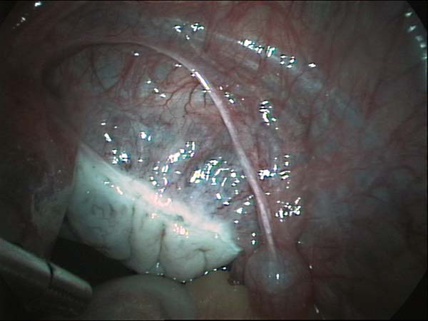 congenital absence of fallopian tube, replaced by a band