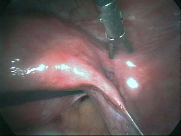 fallopian tube after salpingectomy