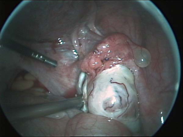 fallopian tube cyst