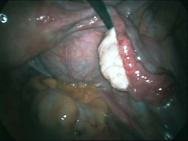 ovary and fallopian tube