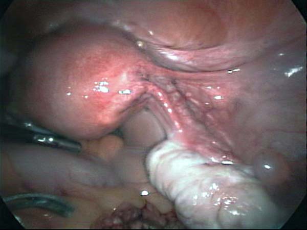 uterus and ovary