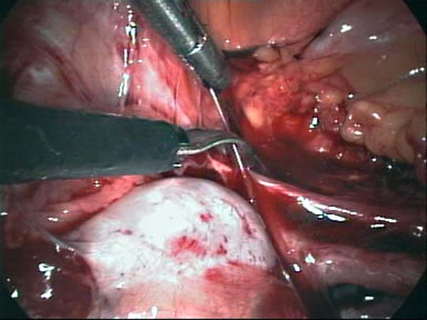 Adhesiolysis