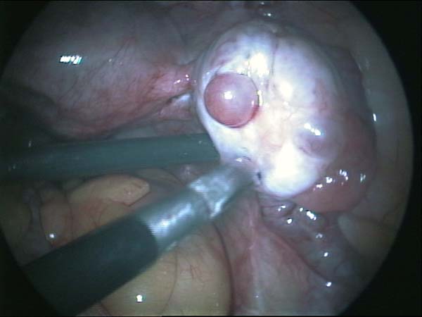 small ovarian cyst