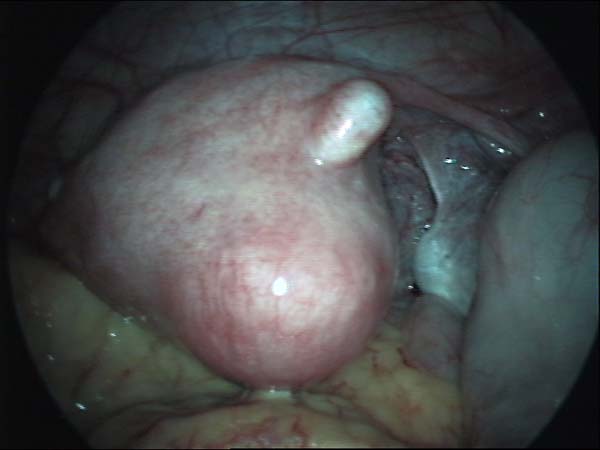 uterine fibroid