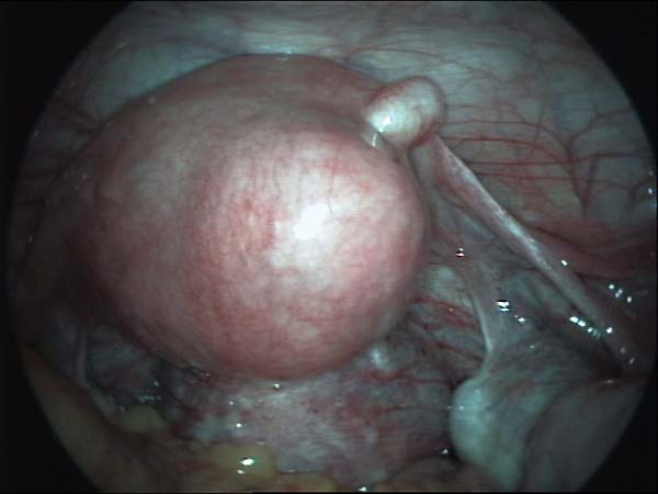 uterine fibroid