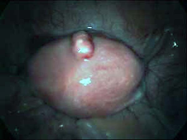 uterine fibroid