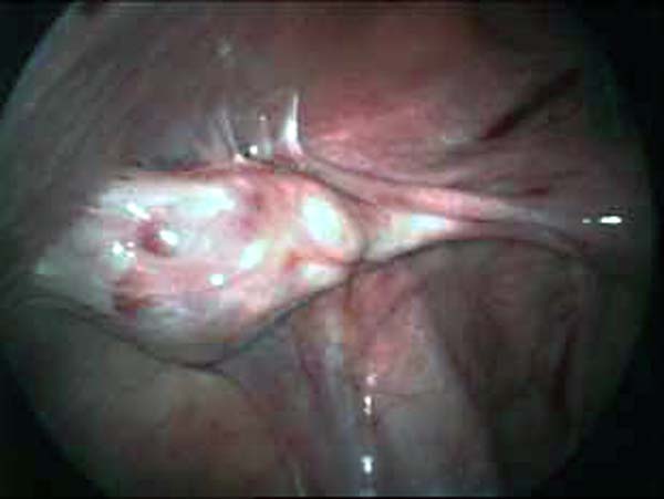 ovary adherent to abdominal wall