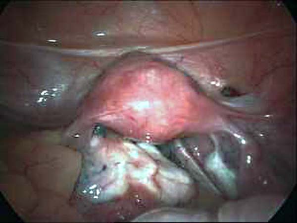 uterus with ovarian adhesions